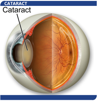 Cataract