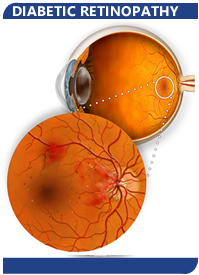 Diabetic Retinopathy