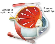 Glaucoma