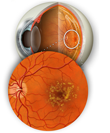 Dry Macular Degeneration