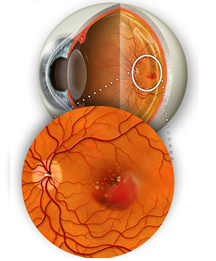 Dry Macular Degeneration
